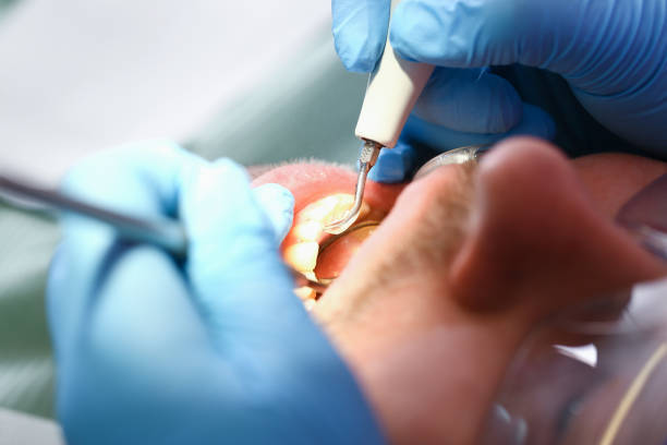 Best Emergency Root Canal Therapy in Morrice, MI